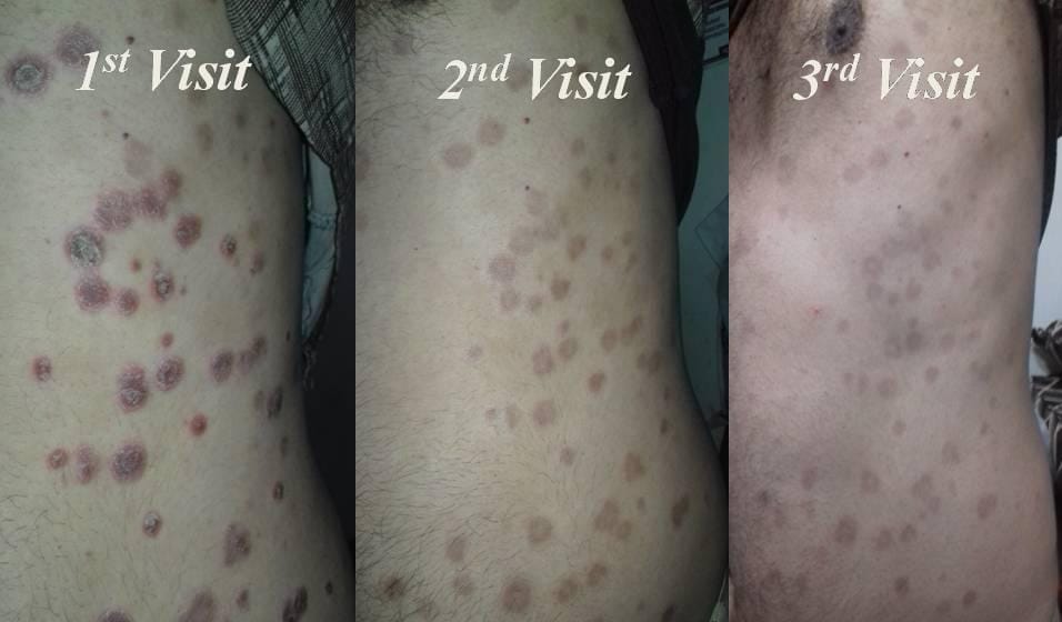 Rajnikant0257's tweet photo. **Ayurvedic Treatment in Dermatology**

Ayurvedic Dignosis:- पित्तप्रधान त्रिदोषज कुष्ठ

⏭️38yrs/M was suffering from Guttate psoriasis since 2 years,It was associated with Severe Burning sensation,Itching and reddish white scaly lession..

⏭️He has taken 3 months of  Ayurvedic medicine for 3 months and shown significant improvement..

#Ayurveda
#Psoriasis
#Dermatology