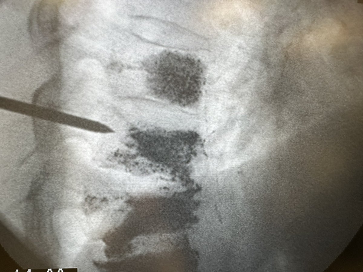 JacobFlemingMD's tweet photo. Two major kypho pearls I've learned in fellowship that have changed my approach completely

Quick 🧵(1/3)

#SpineIR #MskIR #Spine #Ortho https://t.co/xHixw4GVT7