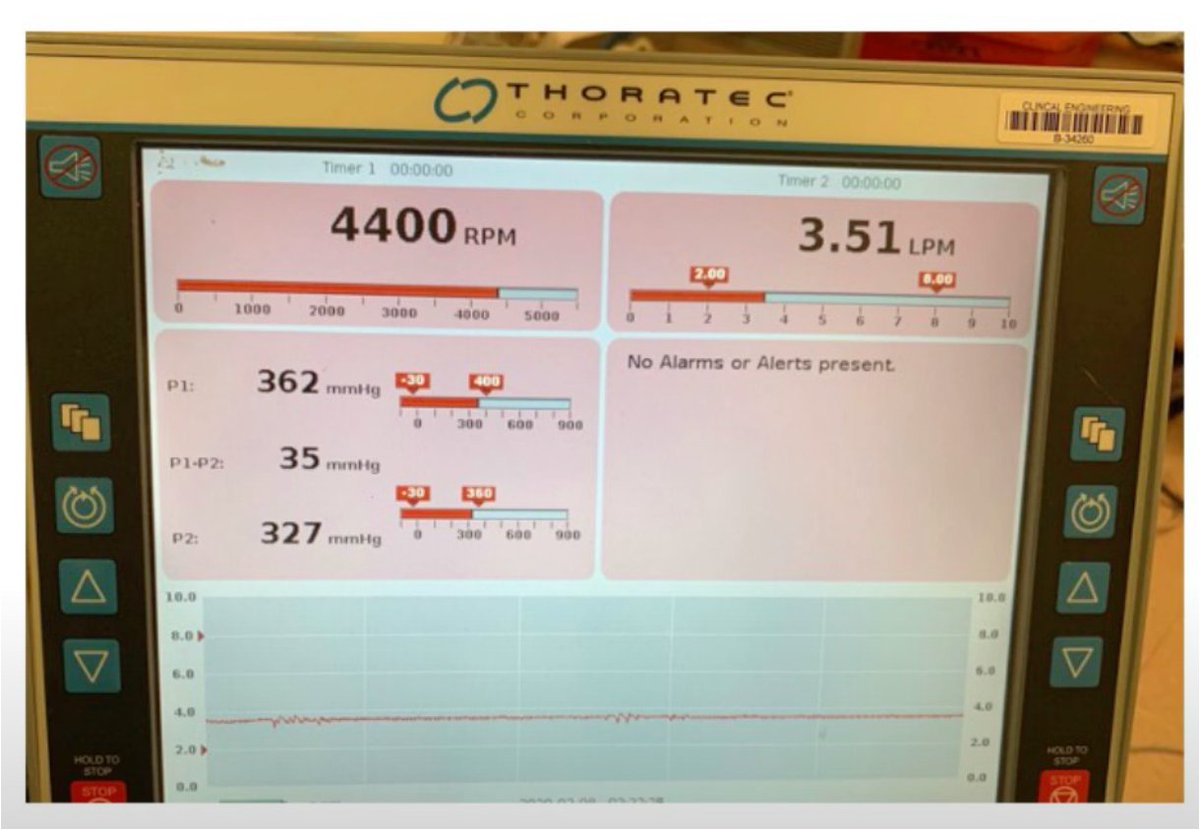 Hanna Knauss MD (@hknaussmd) on Twitter photo You walk in the room of your patient on VA-ECMO & see the following pump display.
How do you interpret those values?
It's ⏰ for our next <a href="/CardioNerds/">CardioNerds</a> thread in the VA-ECMO series of Devices in a Dash! Follow along with the video here: youtube.com/watch?v=t_cDsF…
🧵/1 You walk in the room of your patient on VA-ECMO & see the following pump display.
How do you interpret those values?
It's ⏰ for our next <a href="/CardioNerds/">CardioNerds</a> thread in the VA-ECMO series of Devices in a Dash! Follow along with the video here: youtube.com/watch?v=t_cDsF…
🧵/1
