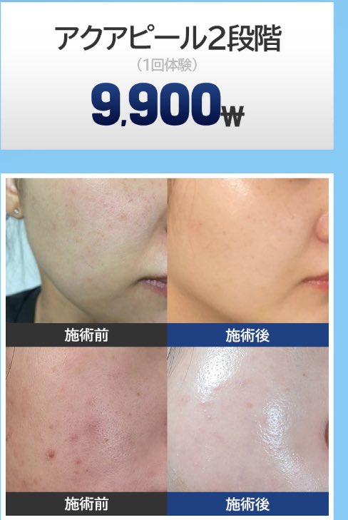 YOURCLINICJP's tweet photo. #江南 で 肌管理がこんなに安いんだって？
やはり #ユアクリニック #yourclinic #江南 #龍山 #禾谷 肌管理イベント
それに  #しわボト1000₩？(江南限定)

#アクアピール  顔全体  2���階 9,900₩
#ララピール 顔全体 6.9万₩
#LDM 顔全体 2.9万₩

リツイートしておいたら、11月以降も適用可能 https://t.co/ZTjpPVcS1R