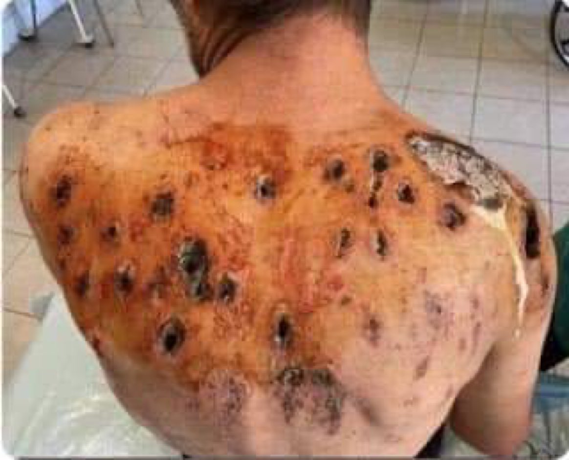 تحذير⚠️: محتوى حساس!
هذا مجرد تذكير بما يفعله الفوسفور الأبيض بجسمك.
وتستخدمه إسرائيل هذه الأيام ضد السكان المدنيين في غزة.

Warning ⚠️: Sensitive content.
Just a reminder of what white phosphorous does to your body. Israel is using it these days on Gaza civilian populations.