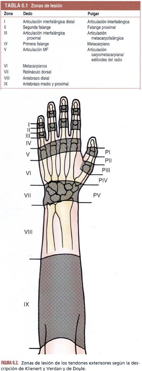 ReviewPlasti's tweet photo. Zonas de lesión extensoras de Klienert y Verdan

Green’s Operative Hand Surgery https://t.co/MmDfHJfKet