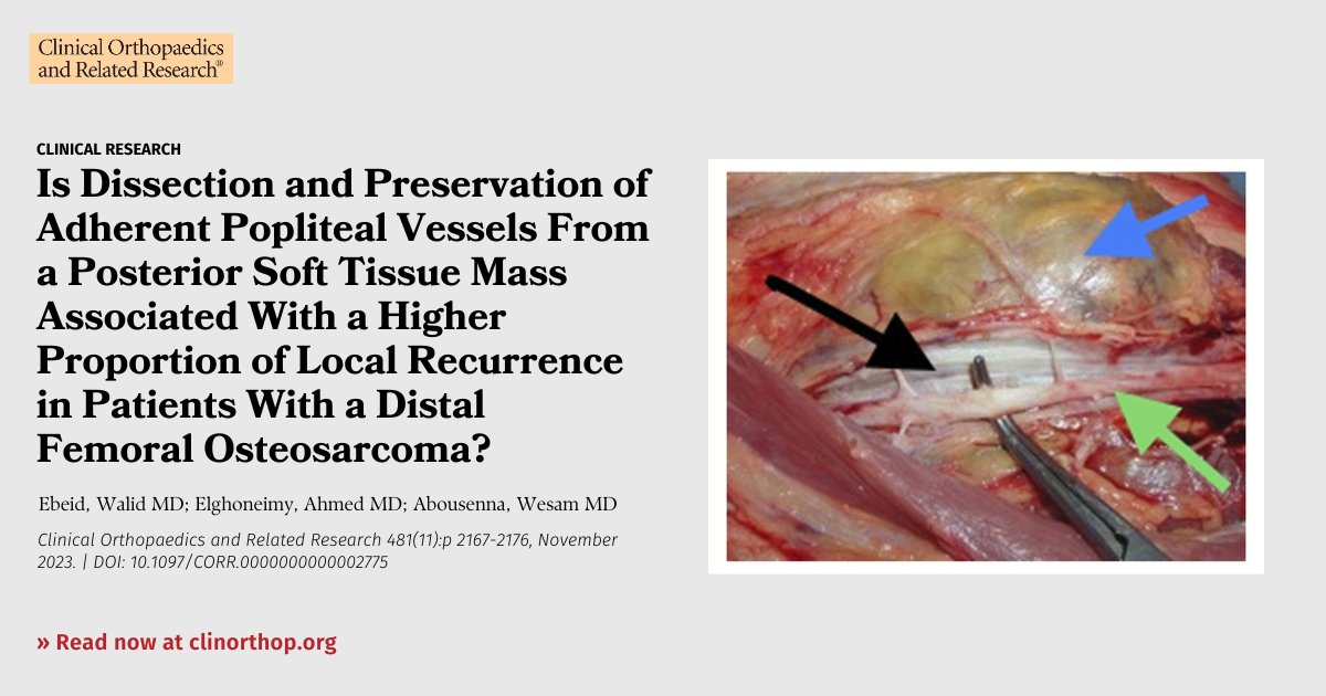 When performing limb salvage for distal femoral osteosarcoma w/adherent vessels, leaving an adventitial margin is associated w/an increase in the incidence of local recurrence & poorer overall survivorship. Read Ebeid et al. in #CORR #tumor #orthoTwitter: ow.ly/RtzN50Q730e