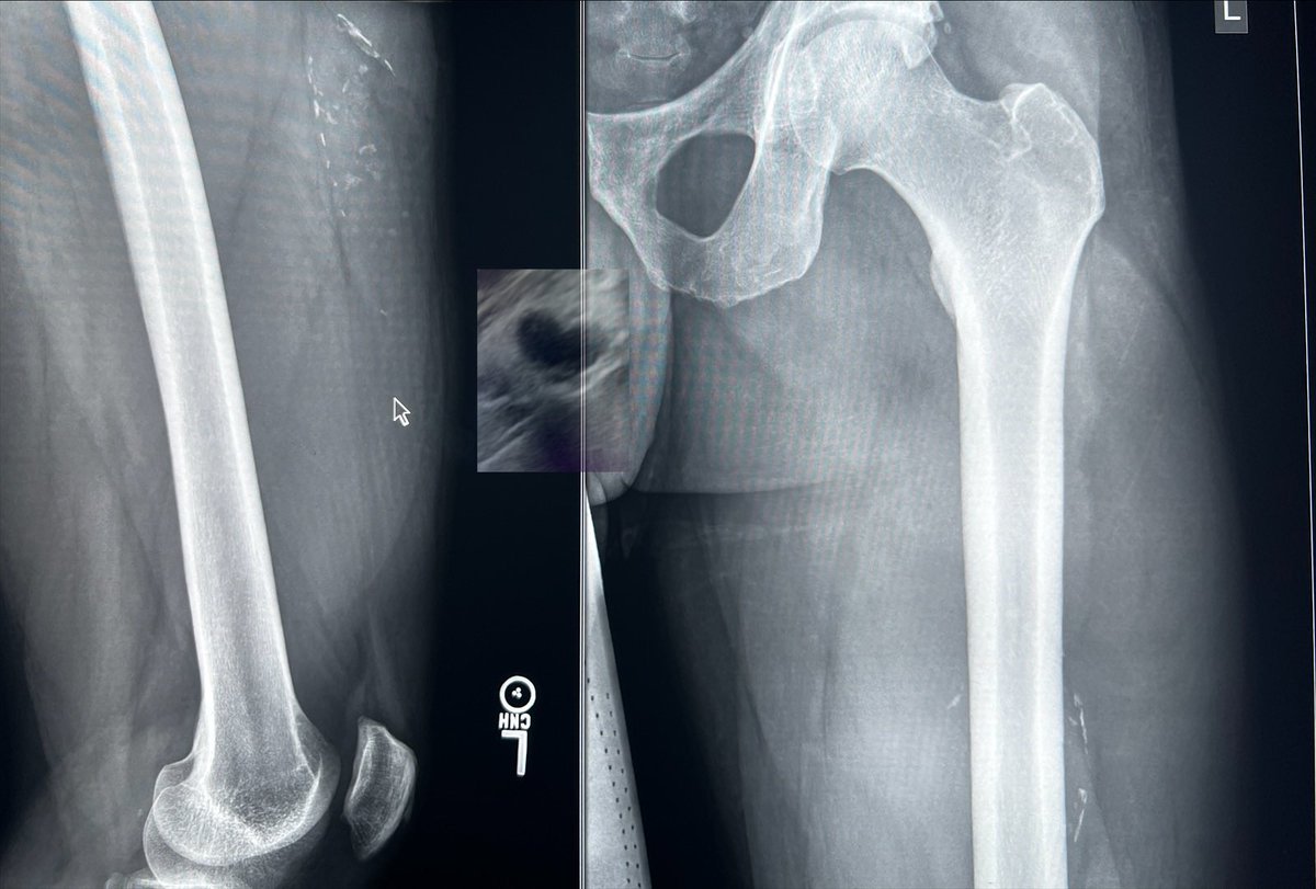 XrayShowNTell's tweet photo. 33M #quad tear in 2011 s/p “drainage” then w cont. pain x6y. 2017 calc. ST lesion ,#hypoechoic, 2019 MR loc +2021^T1/^T2 w int debris = #heme prod. =liquifying ca++ #hematoma. Check out this similar #greatcase of #intramuscularmyxoma @mskteachingroom.@thePakistaniRad @JMcMahonG https://t.co/hbGBtvn5yU