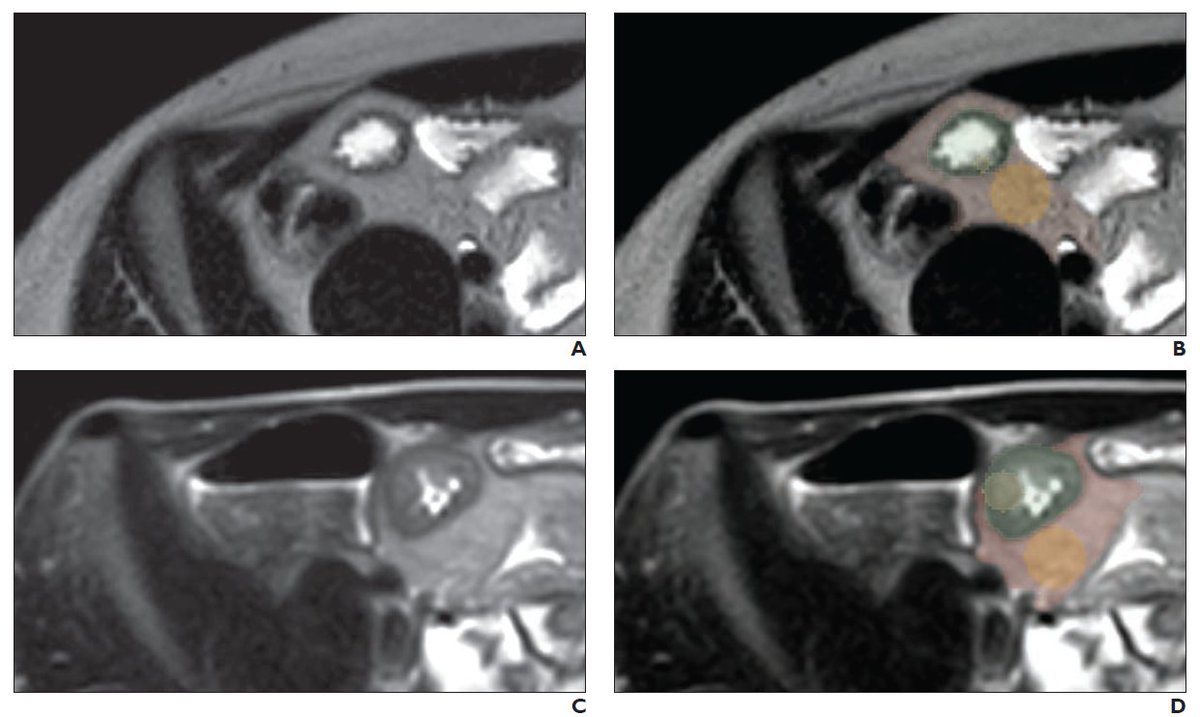Ileal-wall radiomic features were strongly predictive of Crohn disease. The performance of radiomic and clinical ensemble models in diagnosing Crohn disease exceeded that of expert radiologist consensus.

ajronline.org/doi/10.2214/AJ…