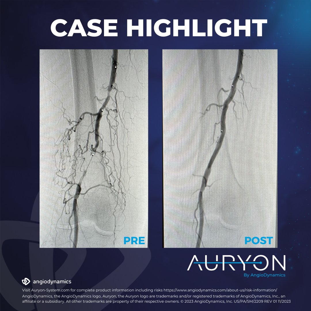 The Auryon Atherectomy System (@auryonpad) on Twitter photo Congrats to Khaled Khalaf, MD of <a href="/VitalHeartVein/">Vital Heart & Vein</a> in Houston, TX on an incredible CTO case utilizing the Auryon System! Dr. Khalaf treated a 62-year-old female with a history of CAD, Diabetes, & current smoker. Dr. Khalaf lasered for 4 min. & 12 sec. See the before & after below! Congrats to Khaled Khalaf, MD of <a href="/VitalHeartVein/">Vital Heart & Vein</a> in Houston, TX on an incredible CTO case utilizing the Auryon System! Dr. Khalaf treated a 62-year-old female with a history of CAD, Diabetes, & current smoker. Dr. Khalaf lasered for 4 min. & 12 sec. See the before & after below!