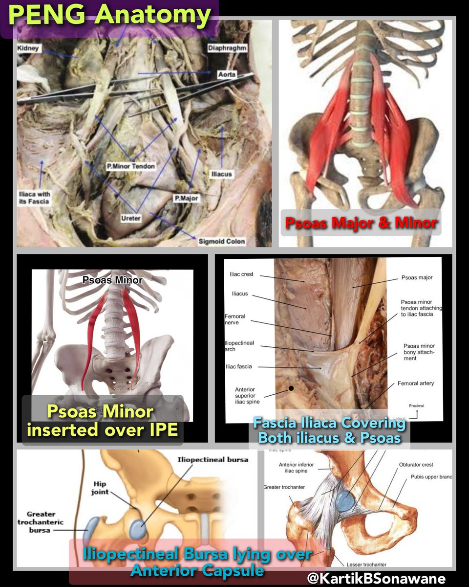 KartikBSonawane's tweet photo. "PENG Block"

Do u know about other Pericapsular Blocks of Hip joint?

#PENGblock
#Pericapsularblocks
#Hipjointanalgesia
#RAinHipSx
#IPPBlock #IlioPsoasPlaneBlock
#ABFNBlock

My 10 Points:

1. A PENG block involves a pericapsular plexus consisting of articular branches (arising from FN, OBN, and accessory OBN) that supply the anterior hip joint capsule. However, two infrainguinal blocks [Iliopsoas plane block (IPP) and Articular Branch of FN (ABFN) block] also cover capsular innervation.
Total 3 Pericapsular blocks: 1 suprainguinal (PENG) and 2 infrainguinal (IPP and ABFN).

2. An IPP block with 5-10 ml can have the same coverage as PENG. ABFN block with 20 ml involves articular branches of FN only (not OBN/AOBN).

3. A PENG block with LA volume of up to 20 ml is required to involve all articular branches. However, lower volumes (10-15ml) can have a patchy effect due to inadequate coverage.

4. A PENG block with higher volumes (30-40 mL) is also described to provide analgesia to the acetabulum #, subtrochanteric  #, or femoral shaft #. Higher volumes may involve articular and parent branches (FN and OBN).

5. The target site in the PENG block is the iliopubic eminence (IPE), where the Psoas Minor tendon gets inserted. It appears as a hyperechoic round structure over IPE that gets elevated during LA deposition. The Psoas Major tendon gets inserted over the lesser trochanter of the femur. Both Psoas muscles lie medial to the iliacus muscle within the fascia iliaca.

6.PENG block region can be divided into 3 Zones: WHITE (below Psoas tendon), BLACK (near the femoral nerve and vessels), and GRAY (below the black zone and above the Psoas tendon). The ideal injection site is below the Psoas tendon, i.e., the WHITE zone. BLACK zone injection can be associated with Quadriceps weakness due to FN involvement. GRAY zone injections are common in obese and difficult anatomy patients, leading to mixed effects depending on LA Concentration and Volume.

7. Quadriceps weakness is mainly due to the involvement of FN either due to LA volume (>20 ml), LA concentration (Higher>Lower), or proximity (BLACK zone).

8. The analgesic effect of PENG block is mainly due to the blockade of all innervations of the anterior capsule of the Hip joint. Some suspect possible joint analgesia due to LA deposition in the iliopectineal bursa beneath the psoas tendon, which communicates with the hip joint. However, this bursa lies mainly over the anterior capsule and has no connection to the joint cavity.

9. Possible (SPECULATED )complications of PENG block Include - Laterally, injury to LFCN at the needle entry point while directing the needle towards the target site. Medially, the needle can enter the ureter, especially when the bladder is full (pushing the ureter close to the target site). At the target site, iliopectineal bursitis can develop due to direct needle injury.

10. PENG provides optimum and faster onset analgesia (resting and dynamic) when used as an “on-arrival” block due to complete coverage of the richly innervated and more nociceptive anterior capsule. PENG + LFCN = Perioperative analgesia option.

For other details, Plz Click on,

https://t.co/gmSnN9tOYE

https://t.co/wrOAhHBhri

https://t.co/umqGWp7KHt

If you know any of the interesting points about PENG block, Plz Share.