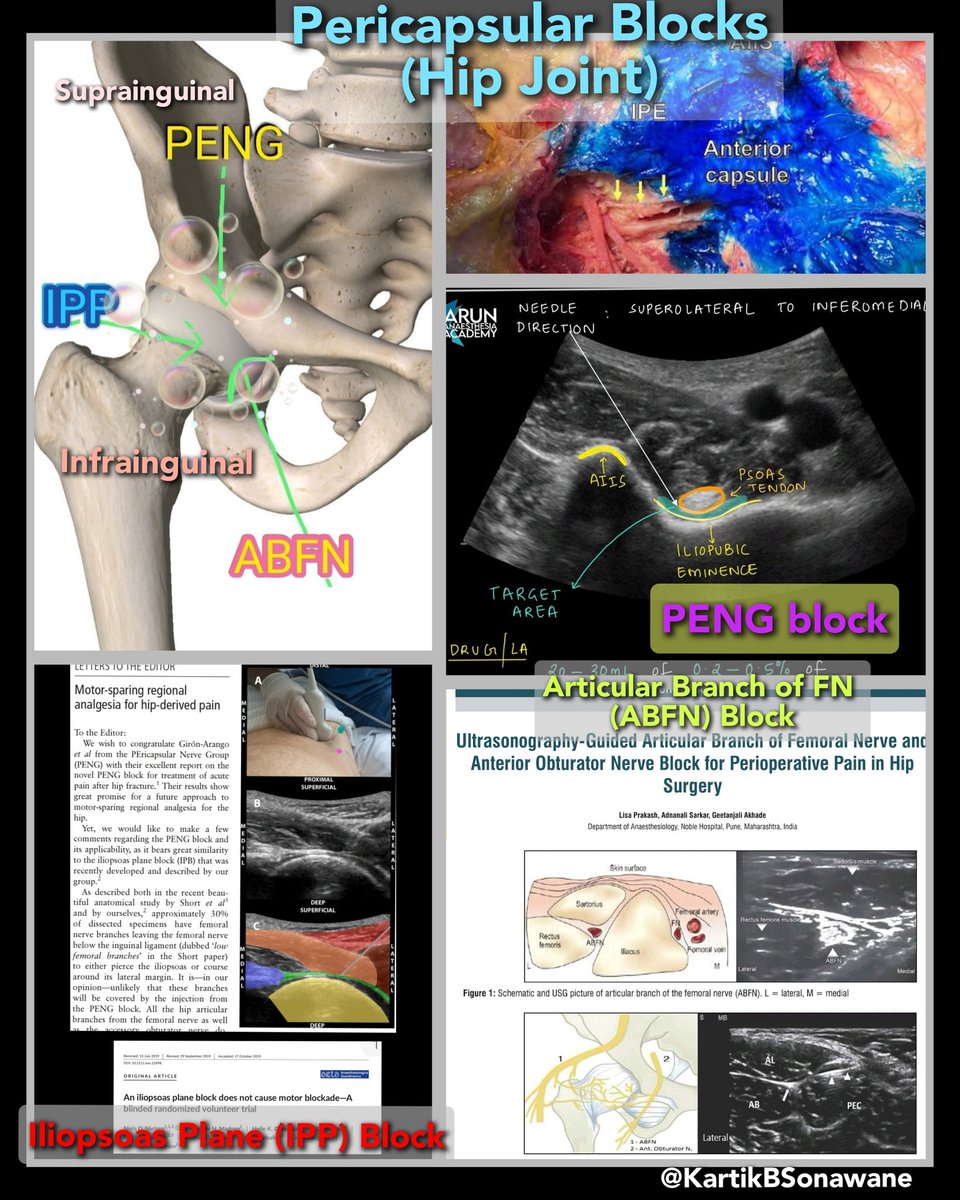 KartikBSonawane's tweet photo. "PENG Block"

Do u know about other Pericapsular Blocks of Hip joint?

#PENGblock
#Pericapsularblocks
#Hipjointanalgesia
#RAinHipSx
#IPPBlock #IlioPsoasPlaneBlock
#ABFNBlock

My 10 Points:

1. A PENG block involves a pericapsular plexus consisting of articular branches (arising from FN, OBN, and accessory OBN) that supply the anterior hip joint capsule. However, two infrainguinal blocks [Iliopsoas plane block (IPP) and Articular Branch of FN (ABFN) block] also cover capsular innervation.
Total 3 Pericapsular blocks: 1 suprainguinal (PENG) and 2 infrainguinal (IPP and ABFN).

2. An IPP block with 5-10 ml can have the same coverage as PENG. ABFN block with 20 ml involves articular branches of FN only (not OBN/AOBN).

3. A PENG block with LA volume of up to 20 ml is required to involve all articular branches. However, lower volumes (10-15ml) can have a patchy effect due to inadequate coverage.

4. A PENG block with higher volumes (30-40 mL) is also described to provide analgesia to the acetabulum #, subtrochanteric  #, or femoral shaft #. Higher volumes may involve articular and parent branches (FN and OBN).

5. The target site in the PENG block is the iliopubic eminence (IPE), where the Psoas Minor tendon gets inserted. It appears as a hyperechoic round structure over IPE that gets elevated during LA deposition. The Psoas Major tendon gets inserted over the lesser trochanter of the femur. Both Psoas muscles lie medial to the iliacus muscle within the fascia iliaca.

6.PENG block region can be divided into 3 Zones: WHITE (below Psoas tendon), BLACK (near the femoral nerve and vessels), and GRAY (below the black zone and above the Psoas tendon). The ideal injection site is below the Psoas tendon, i.e., the WHITE zone. BLACK zone injection can be associated with Quadriceps weakness due to FN involvement. GRAY zone injections are common in obese and difficult anatomy patients, leading to mixed effects depending on LA Concentration and Volume.

7. Quadriceps weakness is mainly due to the involvement of FN either due to LA volume (>20 ml), LA concentration (Higher>Lower), or proximity (BLACK zone).

8. The analgesic effect of PENG block is mainly due to the blockade of all innervations of the anterior capsule of the Hip joint. Some suspect possible joint analgesia due to LA deposition in the iliopectineal bursa beneath the psoas tendon, which communicates with the hip joint. However, this bursa lies mainly over the anterior capsule and has no connection to the joint cavity.

9. Possible (SPECULATED )complications of PENG block Include - Laterally, injury to LFCN at the needle entry point while directing the needle towards the target site. Medially, the needle can enter the ureter, especially when the bladder is full (pushing the ureter close to the target site). At the target site, iliopectineal bursitis can develop due to direct needle injury.

10. PENG provides optimum and faster onset analgesia (resting and dynamic) when used as an “on-arrival” block due to complete coverage of the richly innervated and more nociceptive anterior capsule. PENG + LFCN = Perioperative analgesia option.

For other details, Plz Click on,

https://t.co/gmSnN9tOYE

https://t.co/wrOAhHBhri

https://t.co/umqGWp7KHt

If you know any of the interesting points about PENG block, Plz Share.