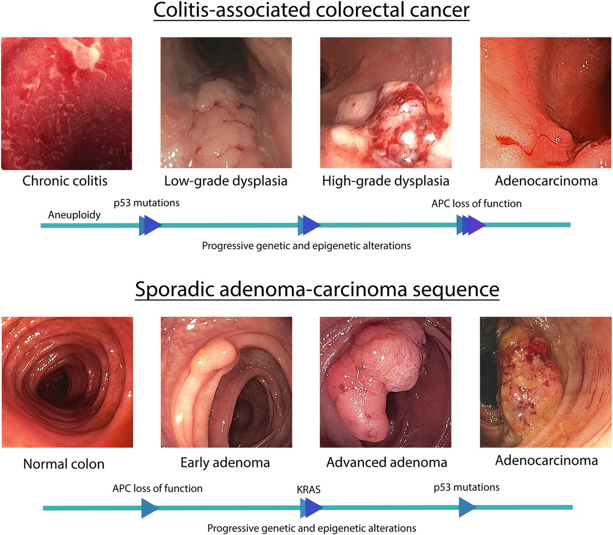 TIGE (@aga_tige) on Twitter photo Can we keep our patients with #IBD safe from #cancer? ow.ly/76LA50Q71TW <a href="/VinayChandraMD/">Vinay Chandrasekhara, MD</a> <a href="/JPGenereMD/">Juan P Reyes Genere</a> Can we keep our patients with #IBD safe from #cancer? ow.ly/76LA50Q71TW <a href="/VinayChandraMD/">Vinay Chandrasekhara, MD</a> <a href="/JPGenereMD/">Juan P Reyes Genere</a>