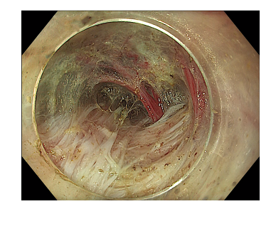 Online now in GIE’s Articles in Press: “Conventional versus oblique fiber–sparing endoscopic myotomy for achalasia cardia: a randomized controlled trial” by Zaheer Nabi et al. giejournal.org/article/S0016-… @ZaheerNabi8