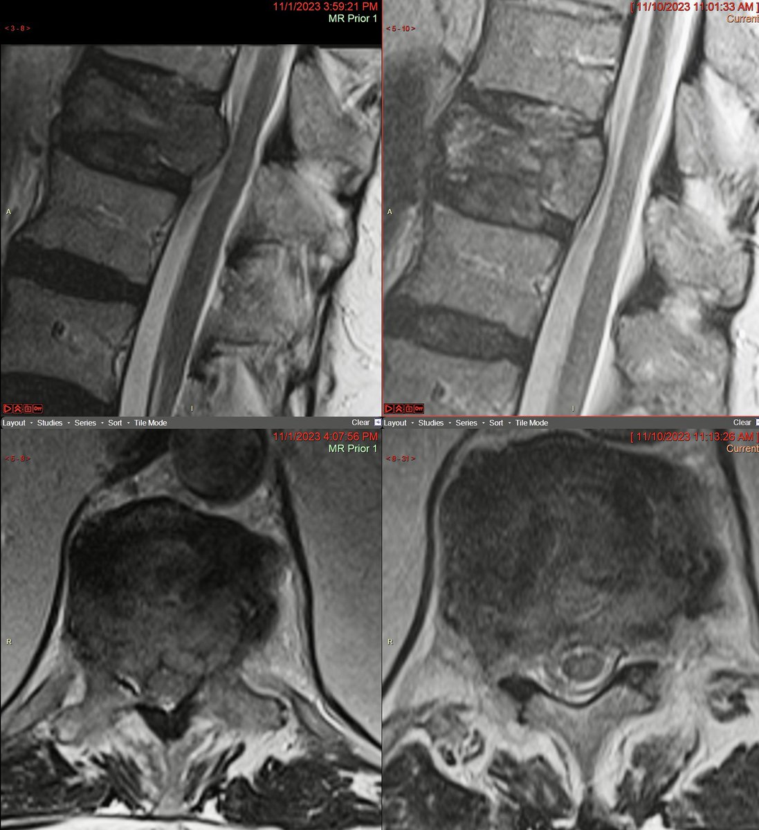 marcelmaya's tweet photo. 89 year-old otherwise healthy man presented with severe back pain due to pathological fracture at T11. #RFA and #SpineJack achieved ligamentotaxis and improved epidural clearance from tumor. Biopsy lymphoma. @The_ASSR @TheASNR #VCF #compression #fracture https://t.co/gccCSOPq35