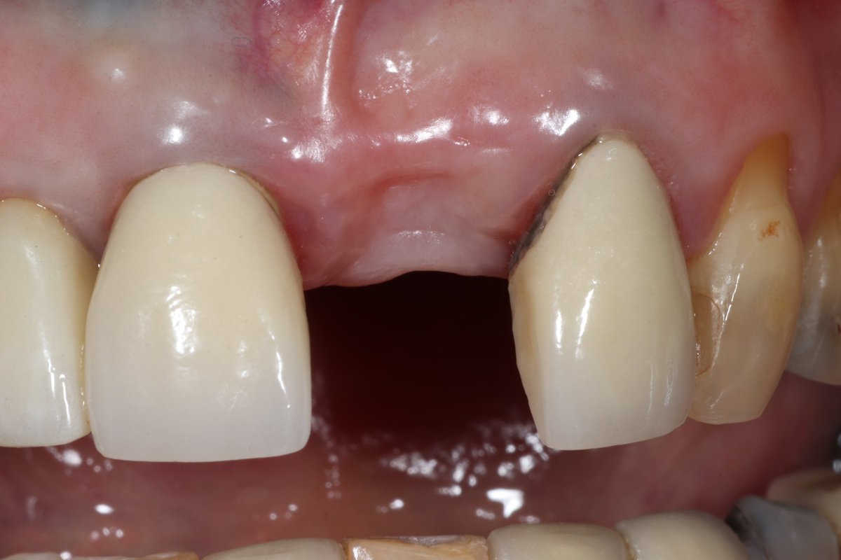 BannonAnthony's tweet photo. This lady didn’t like having a removable denture for her missing tooth and wanted a more permanent solution. We restored her smile using a @StraumannUK implant 🔩 with a beautiful crown made by Alex from @ARTDentalLabor1 ⭐️. #missingtooth #implant #smile #implantdentistry https://t.co/cqpIdeUA4e