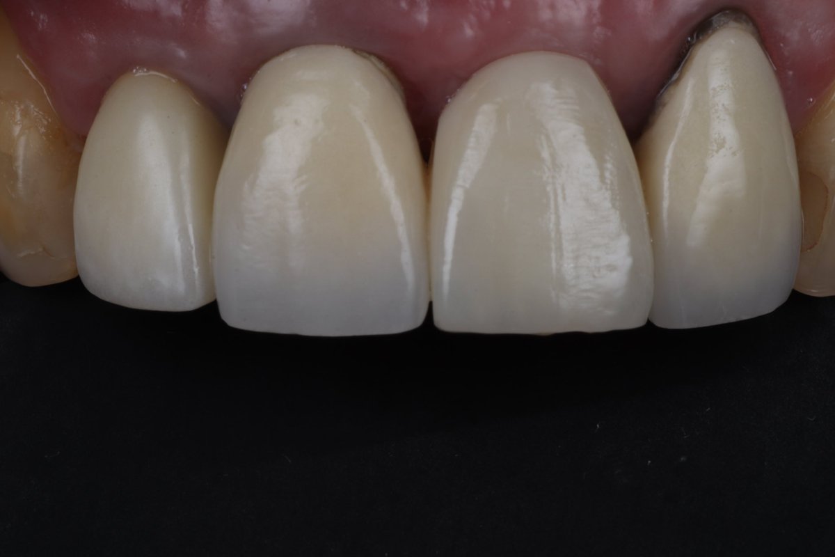 BannonAnthony's tweet photo. This lady didn’t like having a removable denture for her missing tooth and wanted a more permanent solution. We restored her smile using a @StraumannUK implant 🔩 with a beautiful crown made by Alex from @ARTDentalLabor1 ⭐️. #missingtooth #implant #smile #implantdentistry https://t.co/cqpIdeUA4e