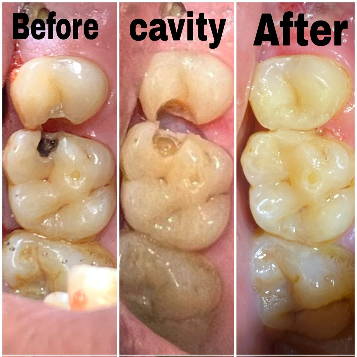 Class 2 composite restoration 
 ( upper left 6&amp;5 )♥️♥️
كل الشكر لاجدع بارتنر <a href="/AhmedElnehraw18/">Ahmed Elnehrawy</a> ♥️