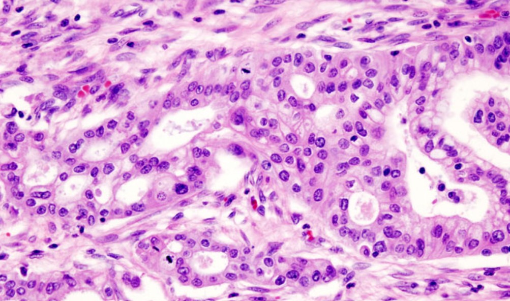 The PRECEDE Consortium aims to improve #PancreaticCancer survival from 11% to 50% in the coming decade. “We're already starting to get some results,” said Diane Simeone, MD, Director of the Pancreatic Cancer Center at @nyulangone. ow.ly/ckz950Q70R3 @MadameSurgeon