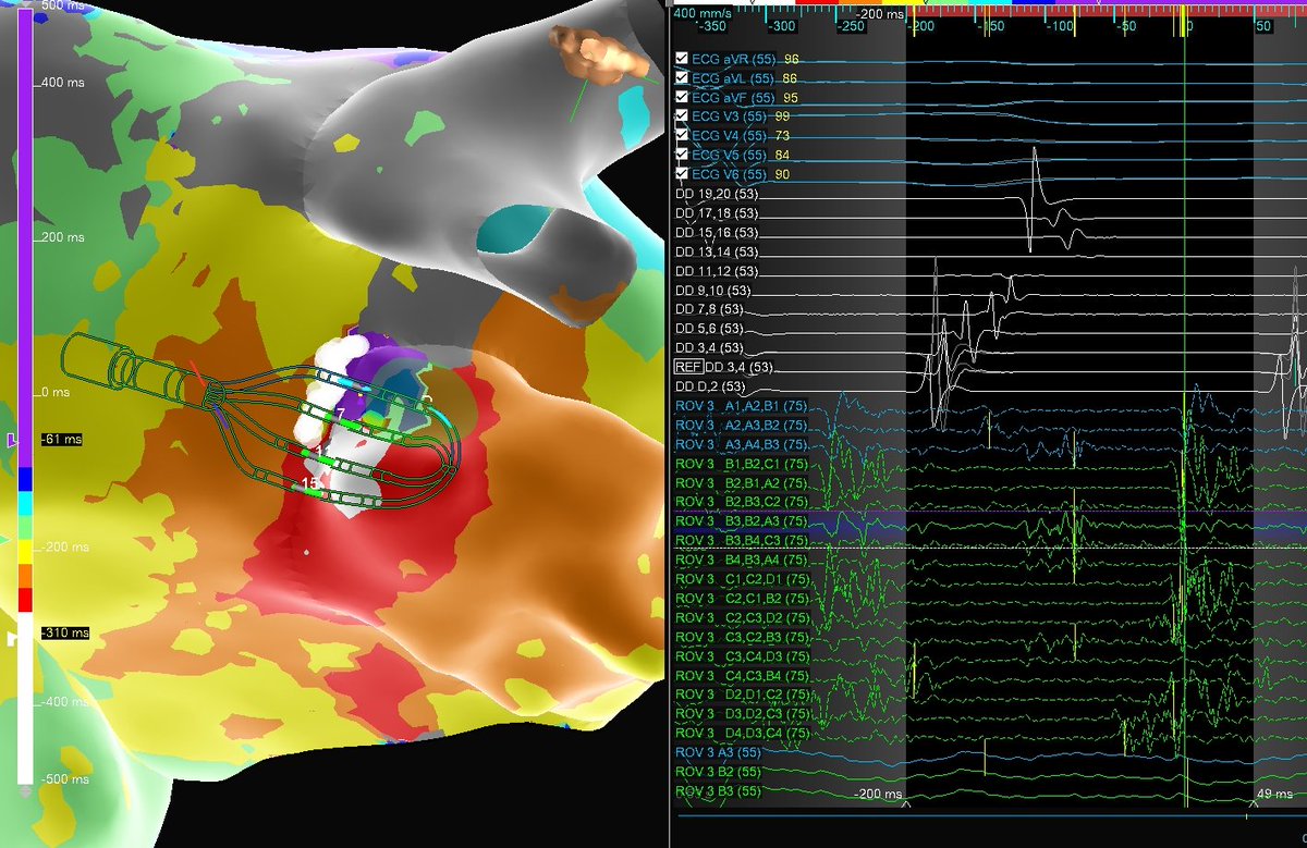 JuanBurnTerm's tweet image. Micro-reentrant AT Mondays?!? Let&apos;s go! 🎯

Entire re-entrant circuit on the Grid
EGMs imperceptible on recording system &amp;lt;0.06 mV

Annotated automatically based on frequency w #OTNF

One burn term 🔥🔥#MapMoreBurnLess

@AbbottCardio