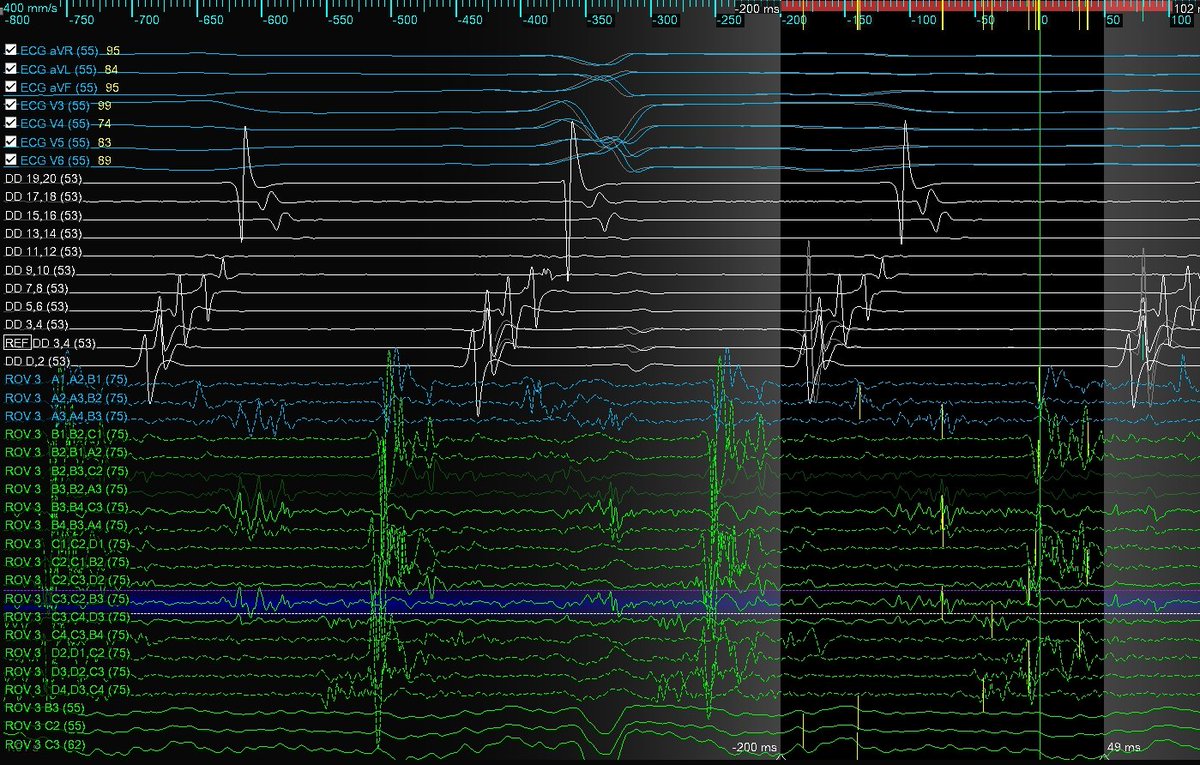 JuanBurnTerm's tweet image. Micro-reentrant AT Mondays?!? Let&apos;s go! 🎯

Entire re-entrant circuit on the Grid
EGMs imperceptible on recording system &amp;lt;0.06 mV

Annotated automatically based on frequency w #OTNF

One burn term 🔥🔥#MapMoreBurnLess

@AbbottCardio