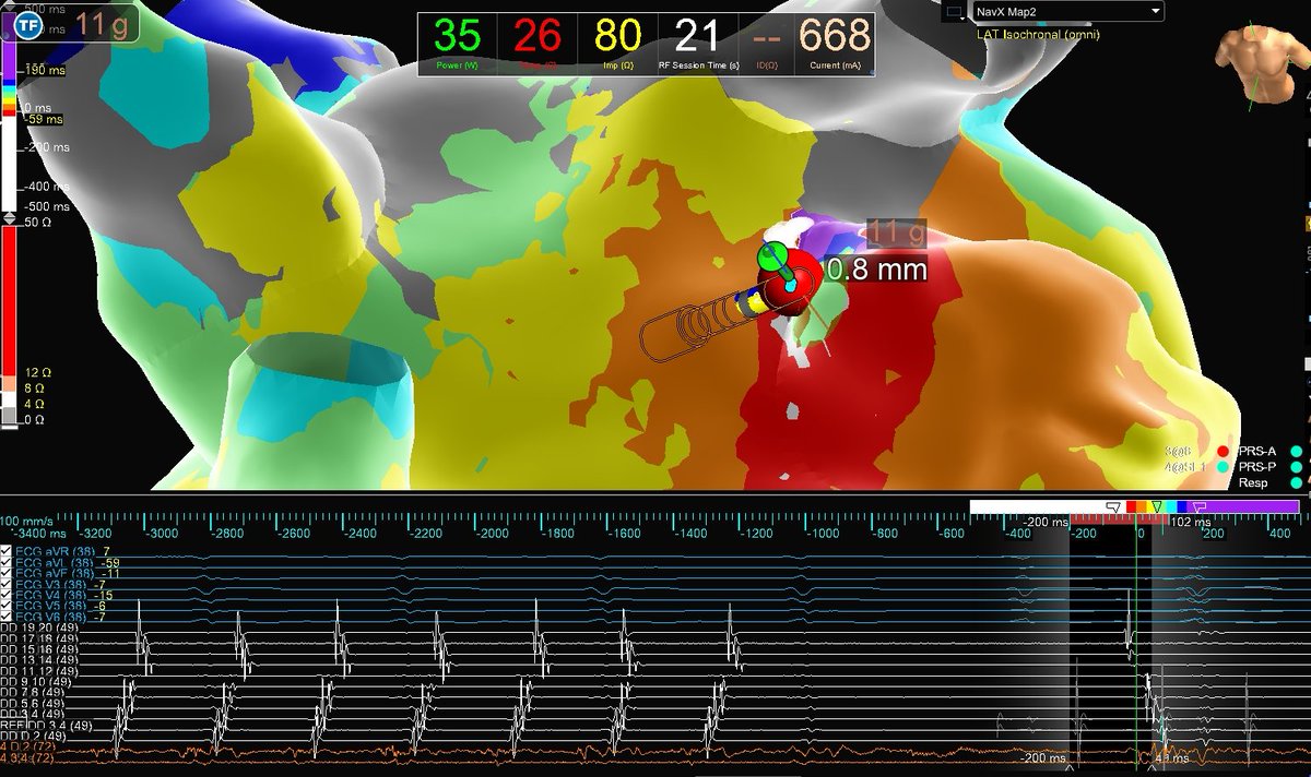 JuanBurnTerm's tweet image. Micro-reentrant AT Mondays?!? Let&apos;s go! 🎯

Entire re-entrant circuit on the Grid
EGMs imperceptible on recording system &amp;lt;0.06 mV

Annotated automatically based on frequency w #OTNF

One burn term 🔥🔥#MapMoreBurnLess

@AbbottCardio