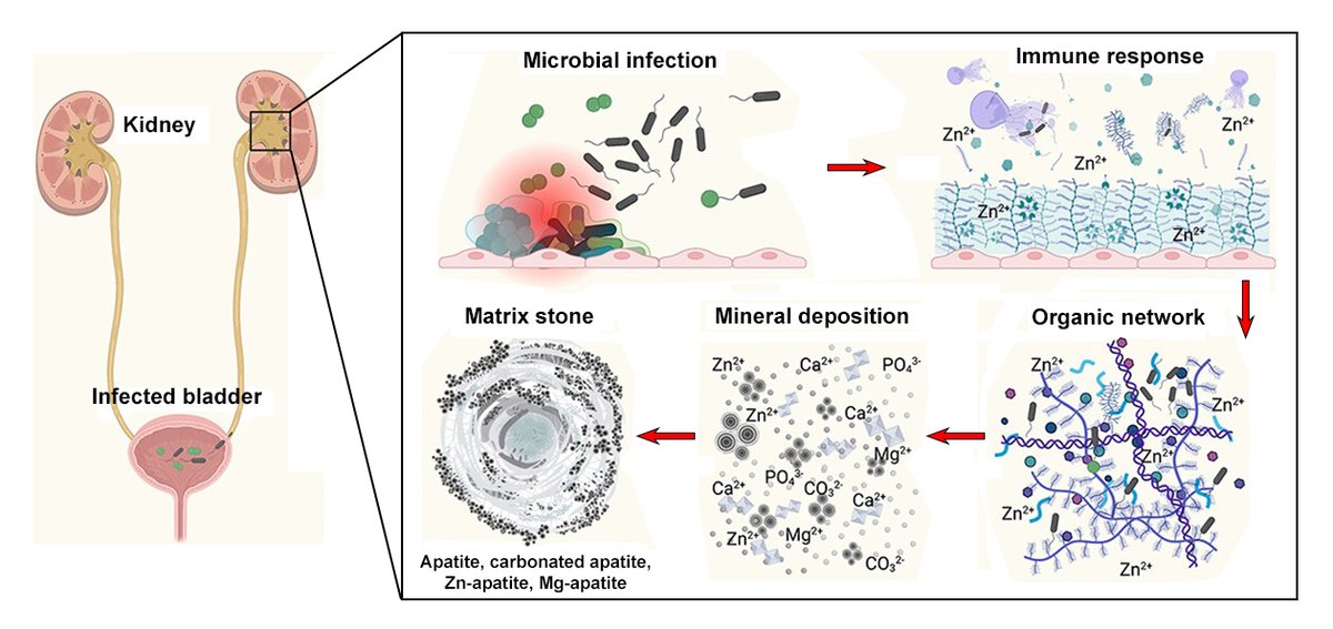 Matrix stones are a rare type of soft kidney stone associated with the presence of bacteria from unchecked urinary tract infections. A recent study highlights how host defense mechanisms against these microbes can encourage harmful matrix stone formation. als.lbl.gov/immune-respons…