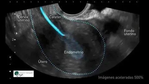 According to our findings, #implantation doesn’t depend on anything you can do or stop doing. Once embryos arrive in the uterus, the endometrium is in charge of the rest. It is as if it cradled the embryos for their implantation in a good spot! bit.ly/3imOj3J
