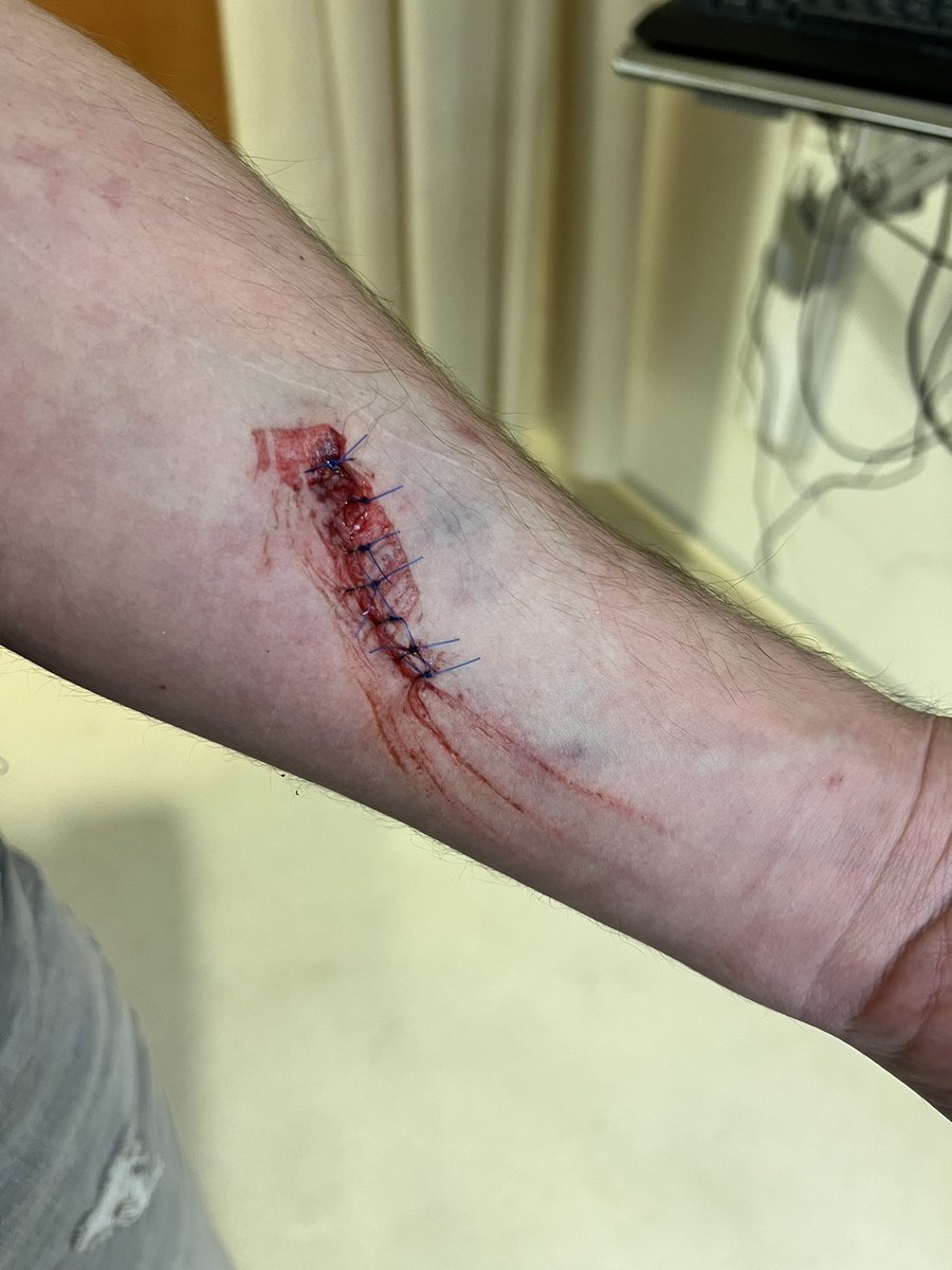 thechrisdenker's tweet photo. 6 hours in the ER
12 stitches
1 night I will never forget

Thank you to DPW, the staff, the insane roster, and every single person in that crowd

I got a lot to improve on and I’m gonna bust my ass to be better every time

For now, I will be on my couch for the next 4 days 😂 https://t.co/rOKM2EeGa4