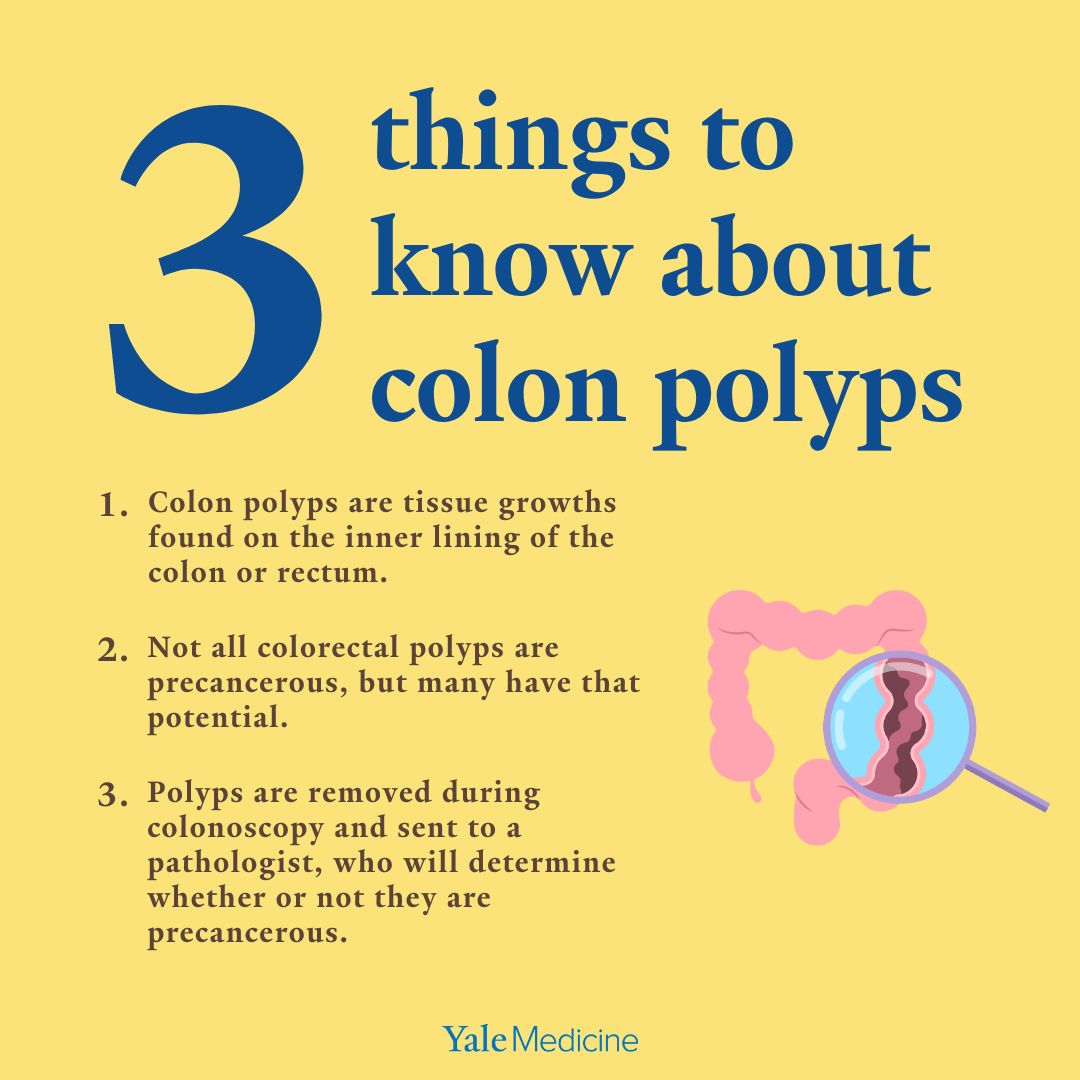 #Colorectal #cancer is the second deadliest cancer in the United States, and many cases start with a small growth (known as a #polyp) in the lining of the #intestine. Read here for what you need to know about #colon #polyps: brnw.ch/21wEpjU