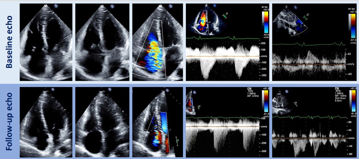 A rare case of marked improvement in tricuspid valve function after surgical resection of a primary carcinoid tumor and initiation of somatostatin analog therapy @CardioUBC @Otavio_Coelho_F @JiwonKimMD @kaznegishi #AHAJournals ahajrnls.org/3MFiSCF