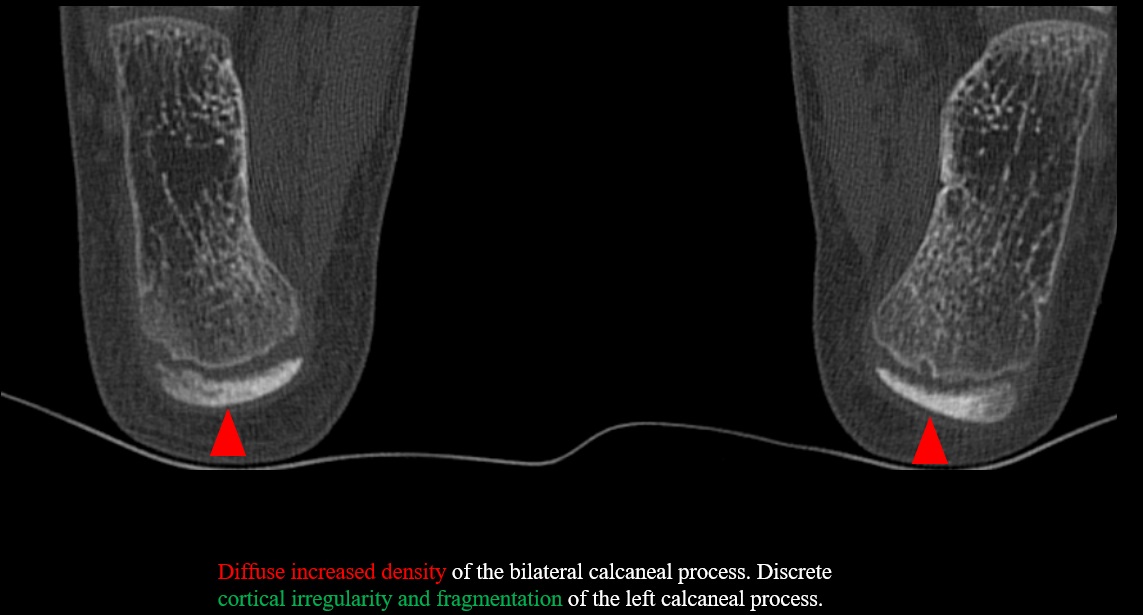 CIC0826's tweet photo. Sportsly active teenager with intense heel pain.
Tomographic findings of calcaneal apophysitis (Sever's disease).
Although the traumatologist diagnoses it clinically, imaging studies can help make a differential diagnosis  (stress fracture, Achilles tendon).
#MSK #radiology https://t.co/HvmhJqgPY2