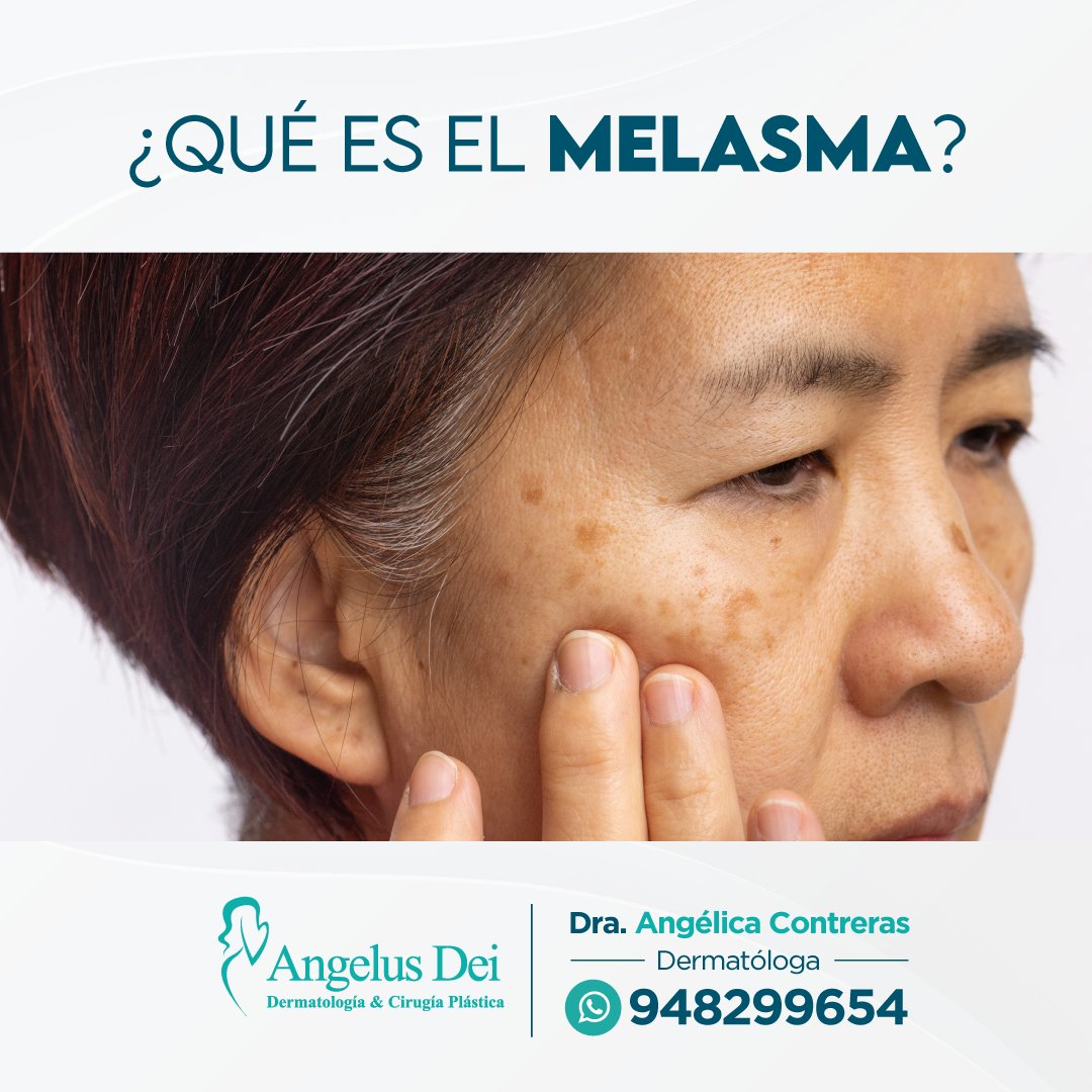 EMAngelusDei's tweet photo. El melasma compromete principalmente frente, nariz, región malar y labio superior. Es una pigmentación marrón en forma de mapa. Se deben a una mezcla de factores hormonales, alteraciones en el funcionamiento de algunas células y exposición solar.👩‍⚕ https://t.co/22efLFnZ0p