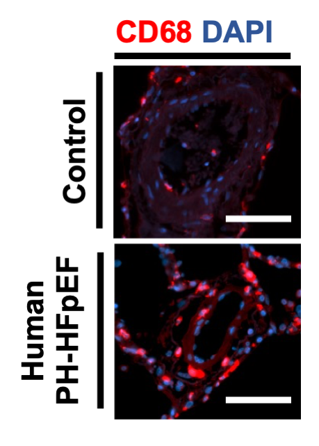 Agrawal & colleagues identify that myeloid-derived #IL1β as a significant contributor pathologic pulmonary vascular remodeling in #HFpEF. Learn more about reversing #PH due to HFpEF at ahajrnls.org/3QDwRdj @VAgrawalMDPhD @JKropski