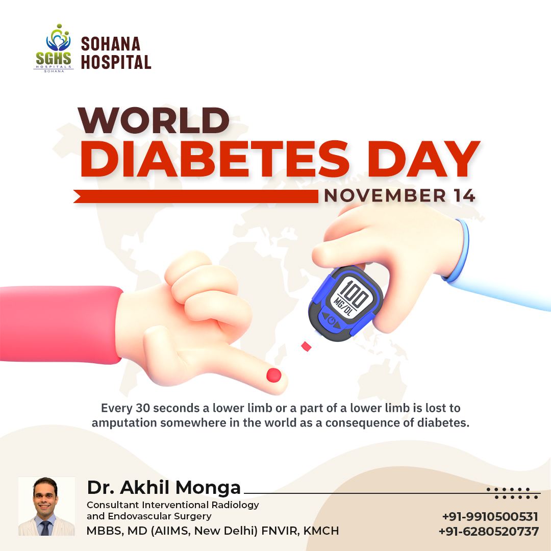 People with Diabetes are more likely to develop non-healing wounds and amputations that require specialized wound treatment. Let us learn more about it to stay protected from it. bit.ly/3X0x64x #Diabetes #DiabetesAwareness #WorldDiabetesDay #WDD2023
