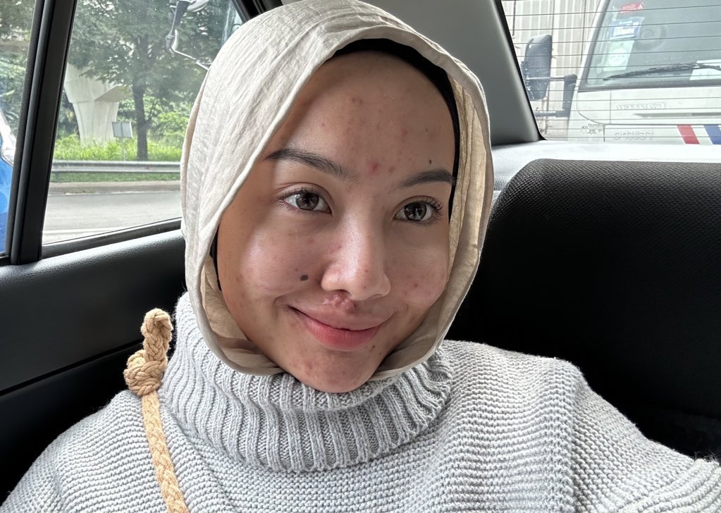 keensalleh's tweet photo. You skin break out and you can’t wear makeup, just wear your confident. My accident scars make me insecure lil bit more sometimes 🫠 but wtever love yourself https://t.co/nG9j6HaOY5