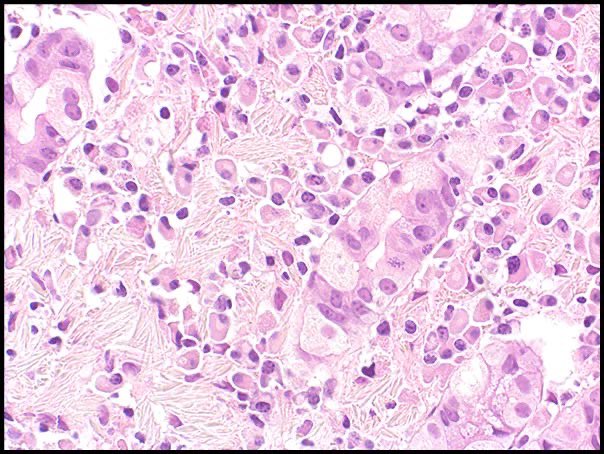 October #COTM is available for review on our website. A 66 yo F presented with RUQ pain, anorexia and east satiety; UGIE revealed Barrett mucosa and single gastric polyp (pictured below) usgips.com/resources/case #pathology #GIpath