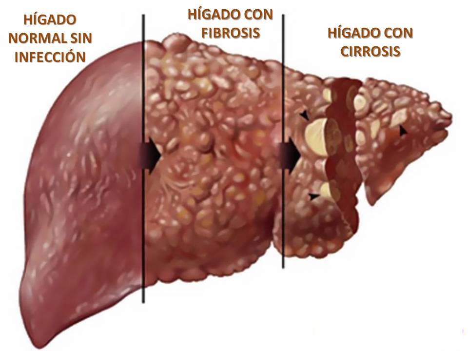 asscatinforma's tweet photo. ❗️La #cirrosis suele detectarse en fases avanzadas, tras 10 o 15 años de su inicio 👉 https://t.co/Z4cPzt9pPU

#44SEMI @Sociedad_SEMI https://t.co/TgV7wBb1q6