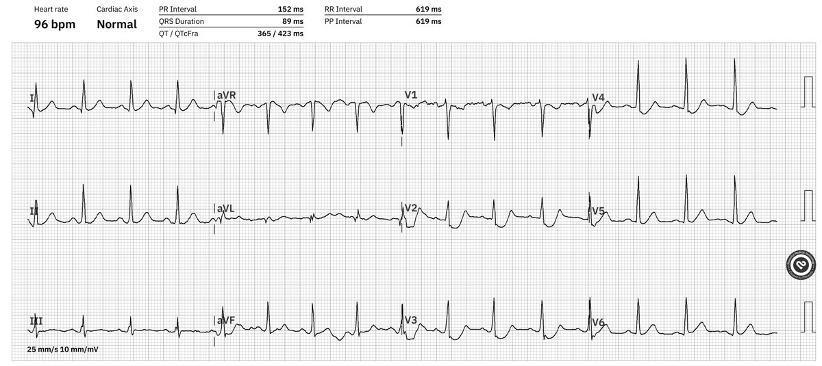 72 year old woman with typical angina since 40 min. Do you need more information for the diagnosis?