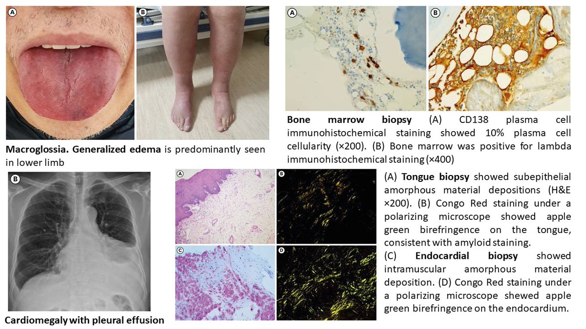 A 75-year-old man with macroglossia and hypercalcemia. Serum-free lambda light-chain level 726.75 mg/L, monoclonal gammopathy and Bence-Jones proteinuria. Your diagnosis? Answer👉bit.ly/47zbRLN #FOAMed #MedEd