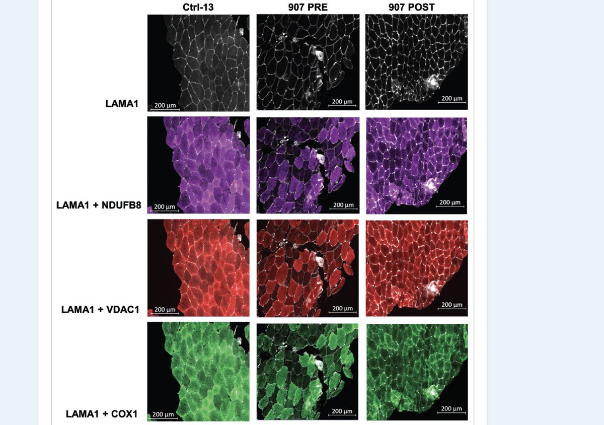 Congrats to <a href="/ValDiLeoMito/">Valeria Di Leo</a> who's work on resistance exercise training in DM1 patients has been published in @journal_ND Read it here: tinyurl.com/yb4hr39 <a href="/MitoResearch/">Mito Research</a> <a href="/jwmdrc/">JWMDRC</a> <a href="/NIHRNewcBRC/">NIHR Newcastle BRC</a> <a href="/nuact_NCL/">Newcastle University Academic Track</a> <a href="/mitomusclelab/">Newcastle Mitochondria and muscle pathology</a>