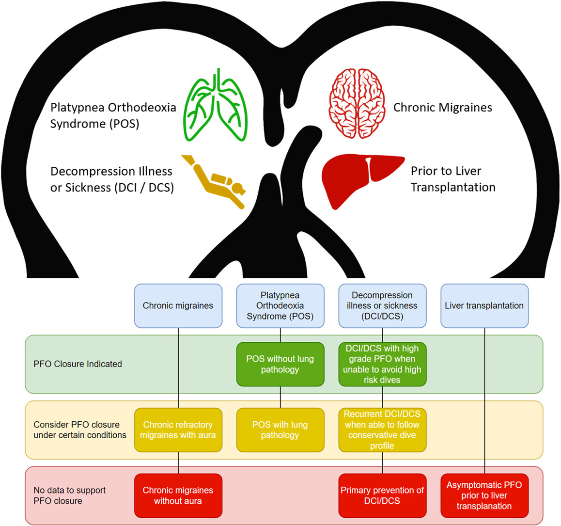 📖Consider PFO closure in the absence of cryptogenic left circulation thromboembolism for hypoxemia due to the right to left shunt, decompression illness, & refractory migraines w aura #PFOClosure ➡️ doi.org/10.1016/j.jsca… @hsuradi @shdcathman