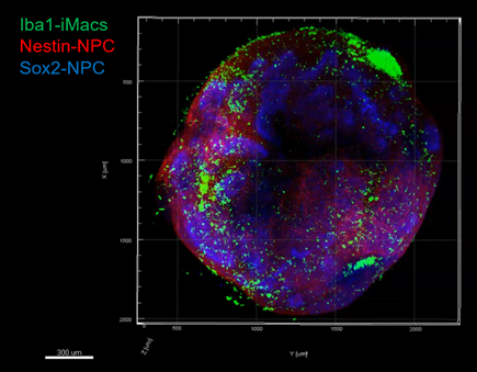 French, Singaporean and British researchers, led by Prof. <a href="/FGinhoux/">@realFlorentGinhoux</a>, head of a research team at <a href="/GustaveRoussy/">Gustave Roussy</a> - <a href="/Inserm/">Inserm</a>, have succeeded in demonstrating in a neuronal organoid the role of the brain's immune environment in its formation and development.

🔗gustaveroussy.fr/en/neural-orga…