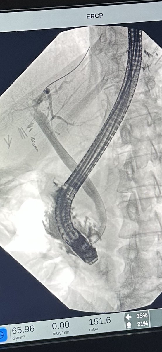 Erik Holzwanger, MD, ABOM-D (@hilarholzy) on Twitter photo Anything interesting here? #GITwitter #MedEd <a href="/Taalamri/">Turki AlAmri |تُرْكي عبدالله الْعَمريَّ MD</a> <a href="/TrieuMD/">Judy Trieu, MD, MPH</a> <a href="/SahajRathi/">Sahaj Rathi MD, DM, MRCP</a> <a href="/DrSalihTokmak/">Salih Tokmak</a> <a href="/ShimaghavimiMD/">Shima Ghavimi</a> <a href="/BilalMohammadMD/">Mohammad Bilal, MD</a> @eric_montminy1 <a href="/TomTielleman/">Tom Tielleman, MD</a> <a href="/GIscope_updates/">EUS & ERCP Master</a> <a href="/MarijoRojasMD/">Mariajose Rojas</a> <a href="/NEndoscopy/">Prof John Leeds</a> <a href="/neilRsharmaMD/">Neil Sharma, M.D. FASGE, FACG, AGAF</a> <a href="/ChahalPrabhleen/">Prabhleen Chahal MD,MASGE,FACG</a> <a href="/CarlKayMD/">Carl Kay, MD</a> <a href="/vaibhav_manu/">Vaibhav Wadhwa</a> <a href="/docdhir/">vinay dhir</a> <a href="/DVinsard/">Daniela Guerrero Vinsard MD</a> Anything interesting here? #GITwitter #MedEd <a href="/Taalamri/">Turki AlAmri |تُرْكي عبدالله الْعَمريَّ MD</a> <a href="/TrieuMD/">Judy Trieu, MD, MPH</a> <a href="/SahajRathi/">Sahaj Rathi MD, DM, MRCP</a> <a href="/DrSalihTokmak/">Salih Tokmak</a> <a href="/ShimaghavimiMD/">Shima Ghavimi</a> <a href="/BilalMohammadMD/">Mohammad Bilal, MD</a> @eric_montminy1 <a href="/TomTielleman/">Tom Tielleman, MD</a> <a href="/GIscope_updates/">EUS & ERCP Master</a> <a href="/MarijoRojasMD/">Mariajose Rojas</a> <a href="/NEndoscopy/">Prof John Leeds</a> <a href="/neilRsharmaMD/">Neil Sharma, M.D. FASGE, FACG, AGAF</a> <a href="/ChahalPrabhleen/">Prabhleen Chahal MD,MASGE,FACG</a> <a href="/CarlKayMD/">Carl Kay, MD</a> <a href="/vaibhav_manu/">Vaibhav Wadhwa</a> <a href="/docdhir/">vinay dhir</a> <a href="/DVinsard/">Daniela Guerrero Vinsard MD</a>