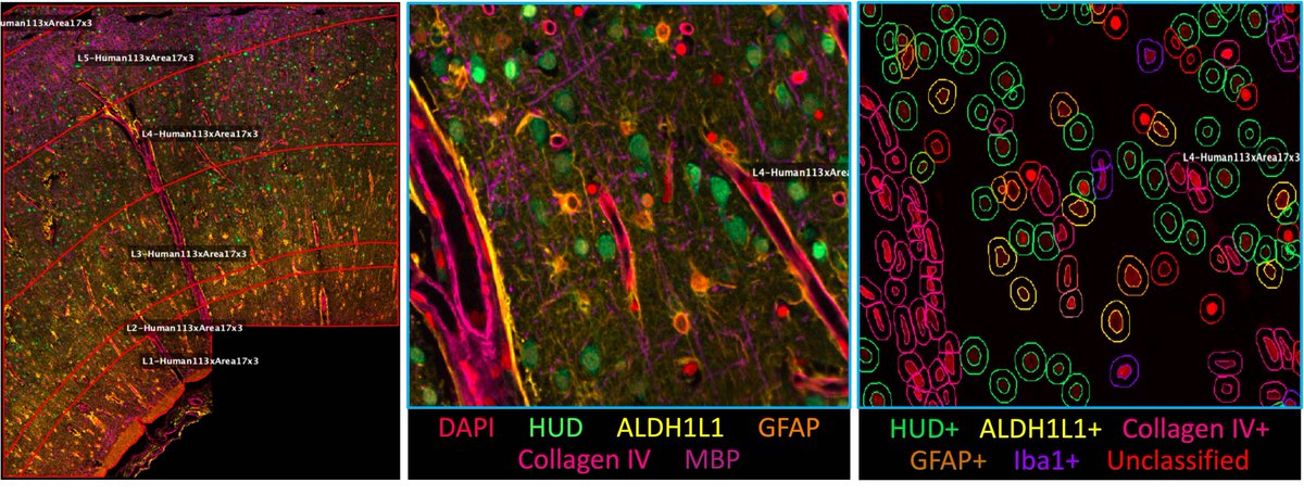 Come speak with #AlecMcKendell (Board E30 PSTR325.20) from 11 am-12 pm today about neocortical glial and vascular changes in Alzheimer's disease. Thanks to @HofLab and @GEResearch for the collaboration behind this first #SfN2023 poster from the #VargheseLab! #FBIatSfN