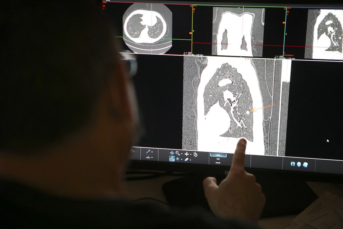 Lung cancer survival rates have risen, but data show racial inequality dlvr.it/Syq0rw