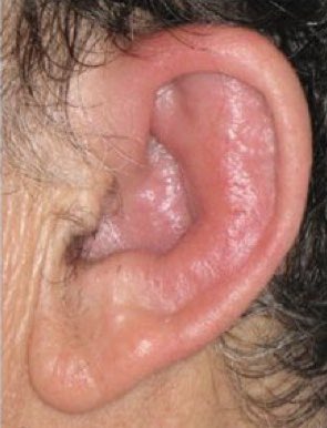 JasmineNephro's tweet photo. ☝️Answer is VEXAS 

hemat 🤝rheumat 

1️⃣V-vacuolated  myeloid/erthroid lineage in marrow-macrocytic anemia/neutropenia/marrow failure

2️⃣E-Mutation in UBA1-lack of cytoplasmic E1

3️⃣X linked-Only 🙋‍♂️

4️⃣A Autoinflmmation-RP/chondroitis/polymyalgia/pleural effusions 

5️⃣S-Somatic https://t.co/EOrhYhu6Ee