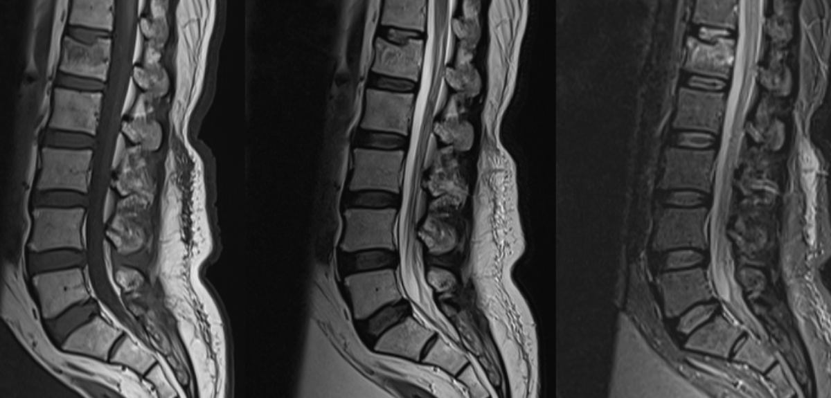 Example of a stable compression fracture of body of L1 vertebra. No bone retropulsion or spinal canal compromise.