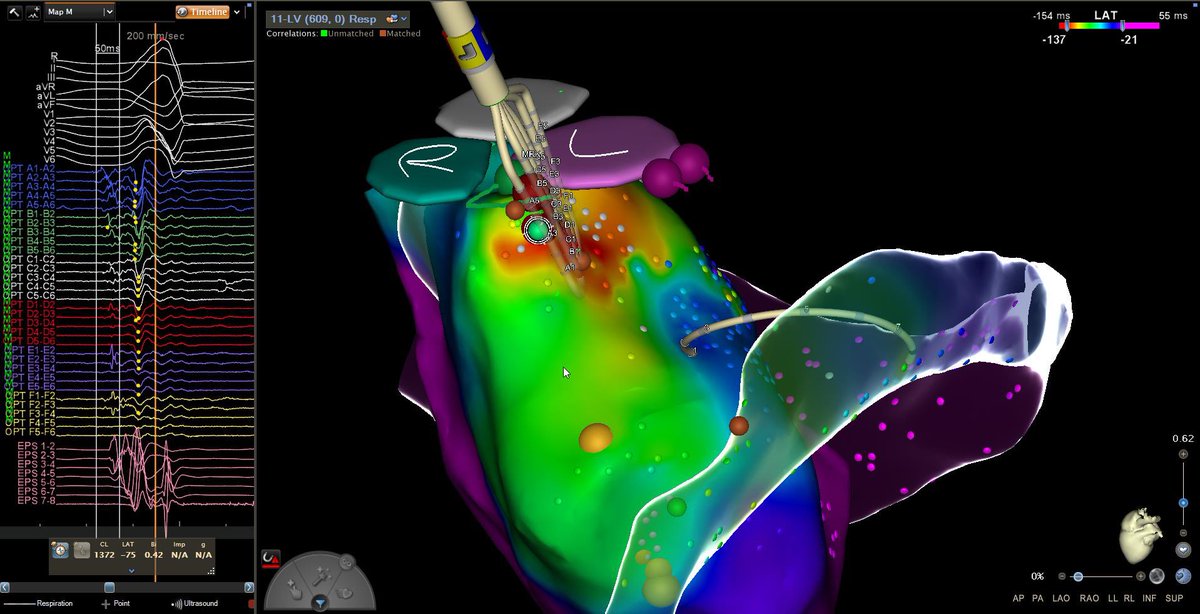 Megna Saha (@megna_saha) on Twitter photo Successful Summit PVC ablation, w/ earliest potentials on #QDOT micro-electrode (-46ms!!) preceding intramyocardial venous early signal (-34ms), and conventional ablation electrode (-11ms). Double QS Unipolar EGM! Thanks to <a href="/CRB_EP/">Chirag Barbhaiya</a> <a href="/nyulangone/">NYU Langone Health</a> <a href="/BijanMohazab/">Bijan Mohazab</a> #EPeeps #RF Successful Summit PVC ablation, w/ earliest potentials on #QDOT micro-electrode (-46ms!!) preceding intramyocardial venous early signal (-34ms), and conventional ablation electrode (-11ms). Double QS Unipolar EGM! Thanks to <a href="/CRB_EP/">Chirag Barbhaiya</a> <a href="/nyulangone/">NYU Langone Health</a> <a href="/BijanMohazab/">Bijan Mohazab</a> #EPeeps #RF