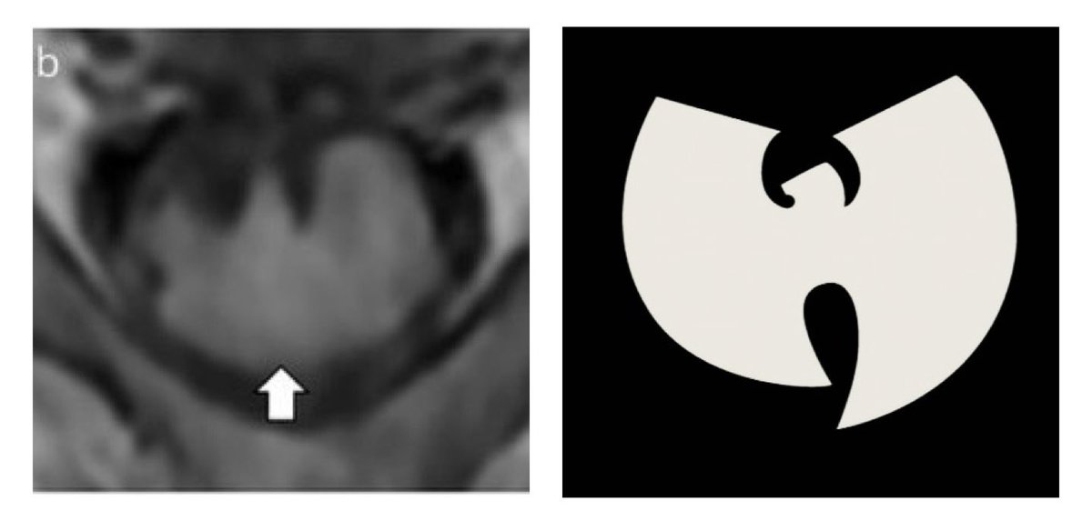 I think maybe they’ve discovered a whole new MRI sign??

Great case and image from Drs. Griffin, Toledano,  <a href="/EoinFlanagan14/">Eoin Flanagan</a> and <a href="/RafidMustafa/">Rafid Mustafa</a>