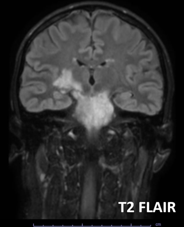 #AJNRcc >> November 13, 2023 >> What is the diagnosis for this 42-year-old man with worsening headache and walking difficulties, accompanied by weakness in his right upper and lower limbs? Submit your answer at ajnr.org/content/quiz/1…