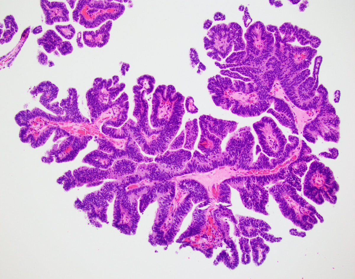 Lara Harik MD (@laraharikmd) on Twitter photo Having fun putting the slides together for the #ISUP presentation tomorrow Wednesday! Hope to see you all there!
Any guesses what this bladder lesion is in a 68 yo male with hematuria and urinary symptoms?
#pathology #PathTwitter #GUPATH <a href="/IntSocUropath/">International Society of Urological Pathology</a> Having fun putting the slides together for the #ISUP presentation tomorrow Wednesday! Hope to see you all there!
Any guesses what this bladder lesion is in a 68 yo male with hematuria and urinary symptoms?
#pathology #PathTwitter #GUPATH <a href="/IntSocUropath/">International Society of Urological Pathology</a>