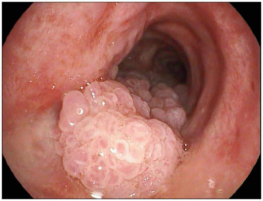 guerreroespejo's tweet photo. 63 años♂️, #VIH +: 3 meses de empeoramiento de tos seca y disnea de esfuerzo
CD4: 81/mm3
Broncoscopia: lesiones sésiles, friables y verrugosas en la pared posterior de la tráquea y en los bronquios principales izq. y dcho.
1/3

DOI: 10.1056/NEJMicm1816077 #Neumología #infecciosas https://t.co/qvaQDT1rsT