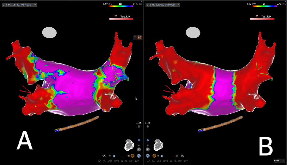 David Kenigsberg, MD (@dkenigsberg) on Twitter photo Voltage maps post PVI done at OSH in ‘21. On pre-map (A), it was evident that the superior veins were not isolated. All PVs underwent single shot isolation using @CardioFocus X3 LB. Note WACA created on the post map (B).
#epeeps
<a href="/Nataliamartin03/">Natalia Martin</a>
<a href="/KyleManico/">Kyle Manico</a>
<a href="/Luiscarto3/">Luis Parada</a> Voltage maps post PVI done at OSH in ‘21. On pre-map (A), it was evident that the superior veins were not isolated. All PVs underwent single shot isolation using @CardioFocus X3 LB. Note WACA created on the post map (B).
#epeeps
<a href="/Nataliamartin03/">Natalia Martin</a>
<a href="/KyleManico/">Kyle Manico</a>
<a href="/Luiscarto3/">Luis Parada</a>